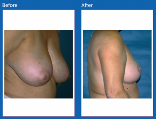 breast-lift-reduction-10