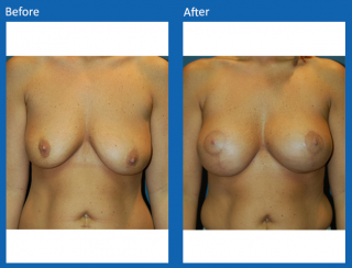 breast-lift-reduction-11