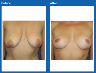 breast-lift-reduction-12
