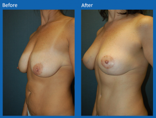 breast-lift-reduction-13