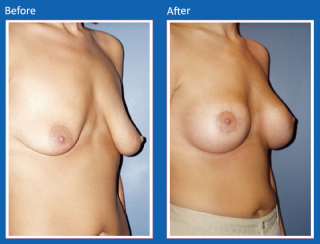 breast-lift-reduction-14
