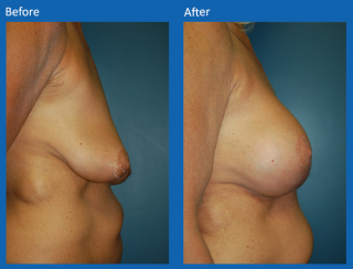 breast-lift-reduction-15
