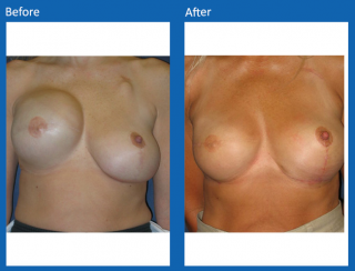 breast-lift-reduction-16