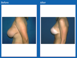 breast-lift-reduction-17