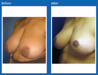 breast-lift-reduction-18