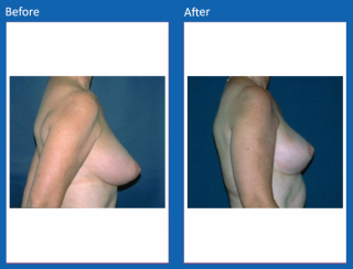 breast-lift-reduction-19
