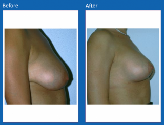breast-lift-reduction-2