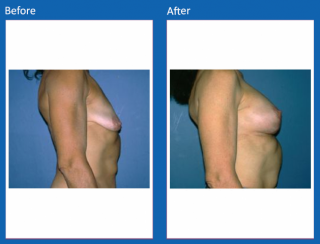 breast-lift-reduction-20