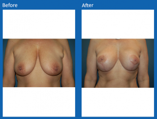 breast-lift-reduction-21