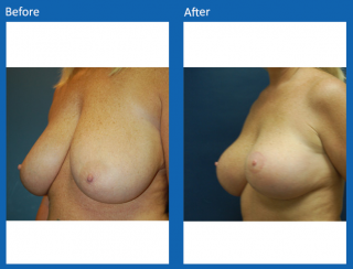 breast-lift-reduction-22
