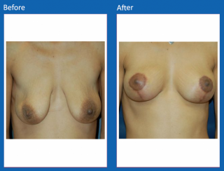 breast-lift-reduction-23