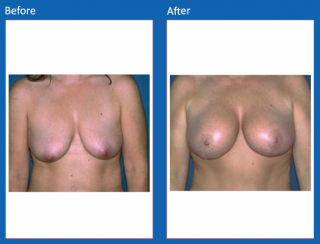 breast-lift-reduction-24