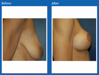 breast-lift-reduction-25