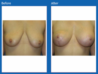 breast-lift-reduction-26