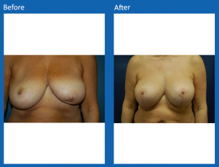 breast-lift-reduction-27