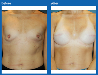 breast-lift-reduction-28