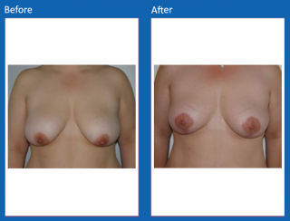 breast-lift-reduction-29