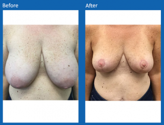 breast-lift-reduction-3