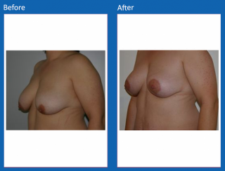 breast-lift-reduction-30