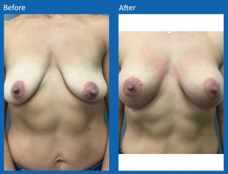 breast-lift-reduction-31