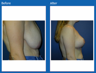 breast-lift-reduction-32