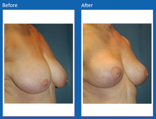 breast-lift-reduction-4