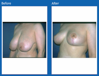 breast-lift-reduction-5