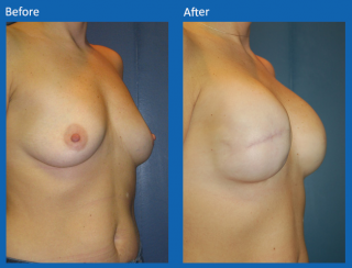 breast-lift-reduction-6