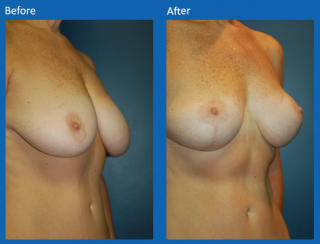 breast-lift-reduction-7