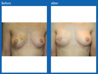 breast-lift-reduction-8