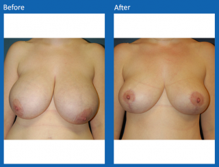 breast-lift-reduction-9
