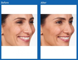 dermal-fillers-update-1