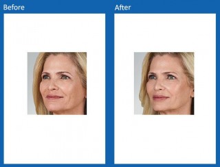 dermal-fillers-update-10