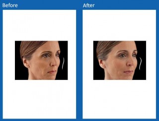 dermal-fillers-update-11