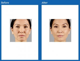 dermal-fillers-update-12