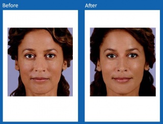 dermal-fillers-update-13