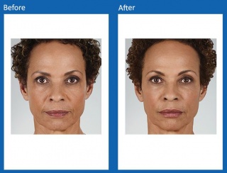 dermal-fillers-update-14