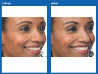 dermal-fillers-update-2