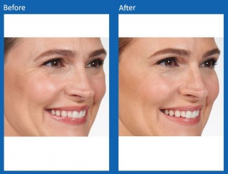 dermal-fillers-update-3