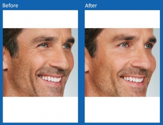 dermal-fillers-update-4