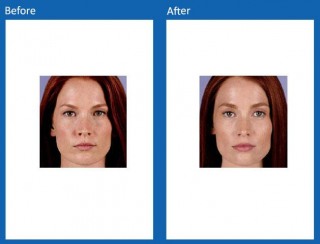 dermal-fillers-update-5