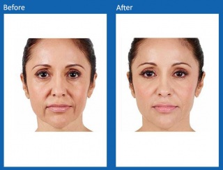 dermal-fillers-update-6
