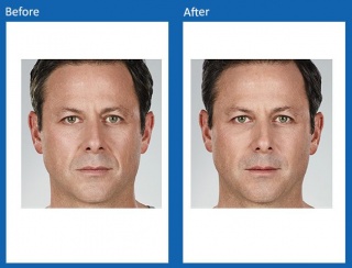 dermal-fillers-update-7