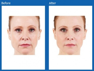 dermal-fillers-update-8