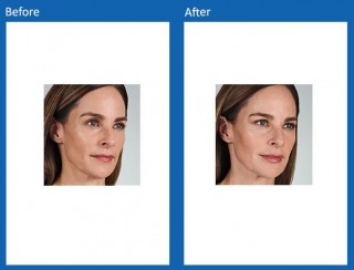 dermal-fillers-update-9