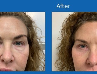 Eye-lid-blepharoplasty