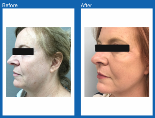 Face-lift-covered