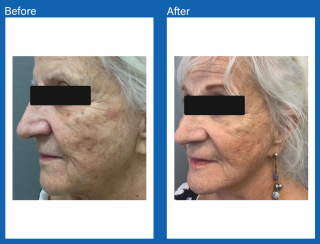 Face-lift-covered2