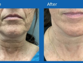 Facelift
