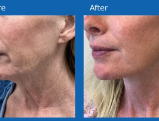 Facelift1